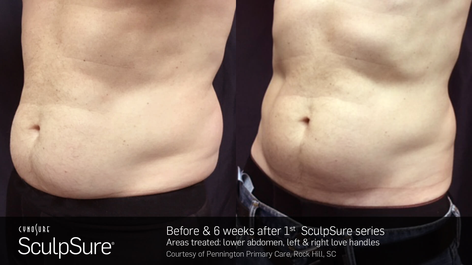 Mens Sculpsure