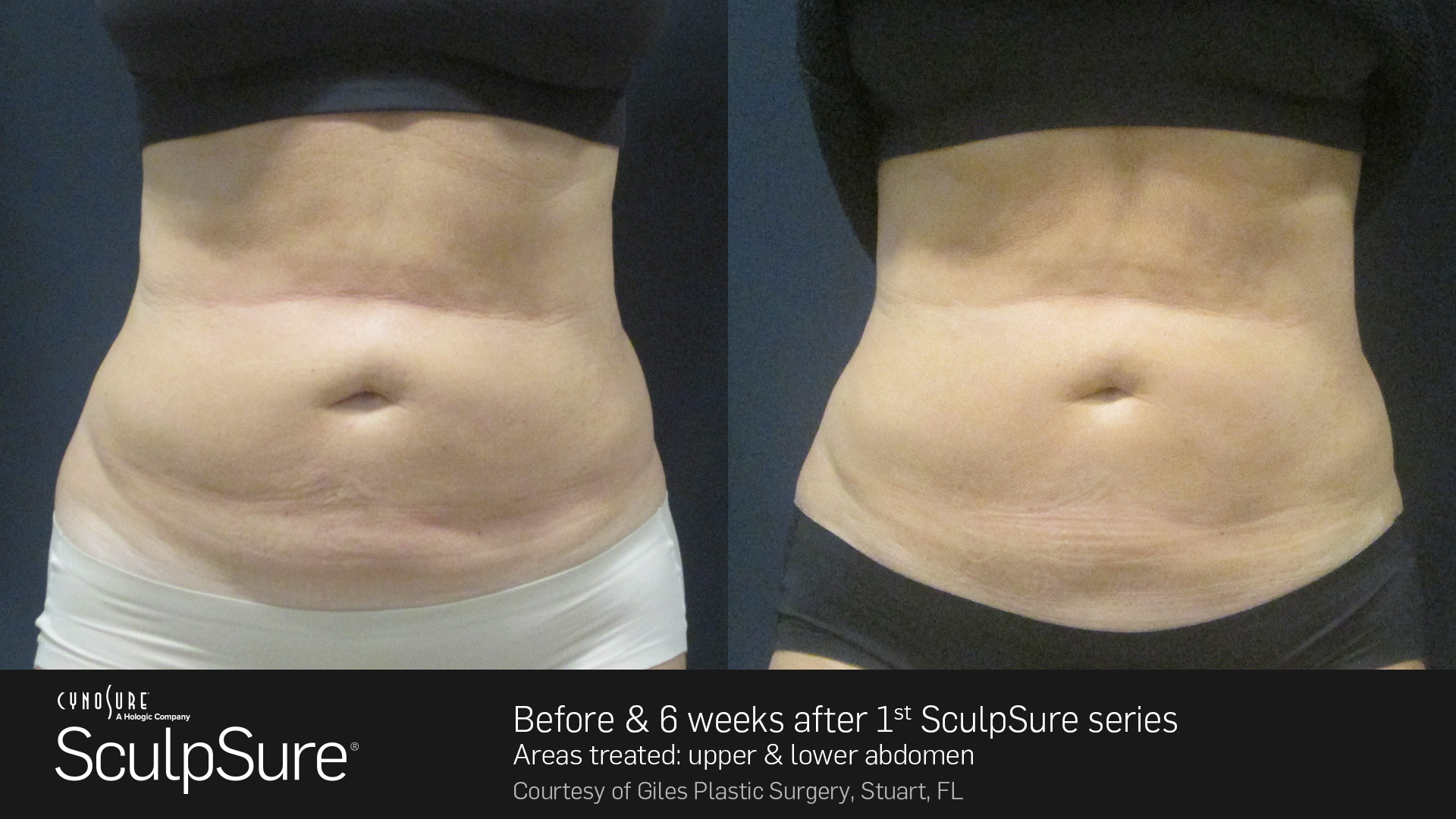 Womens Sculpsure